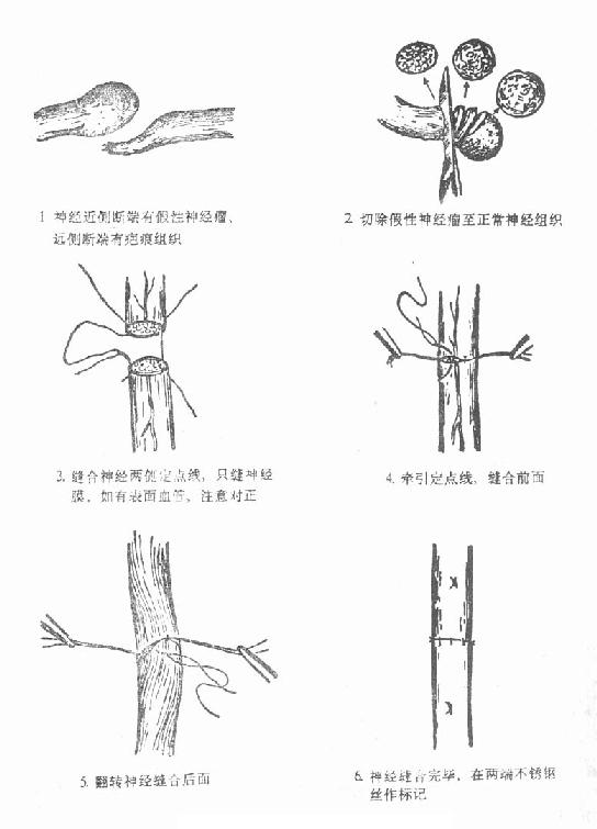 神经外膜缝合示意图