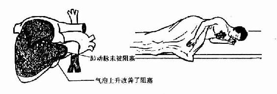 输液空气栓塞
