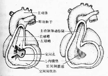 室间隔膜部的形成及室间孔封闭